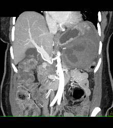 GIST Tumor - CTisus CT Scan