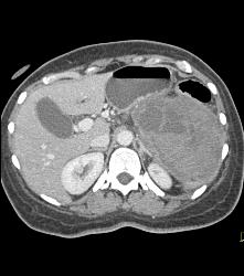 GIST Tumor - CTisus CT Scan