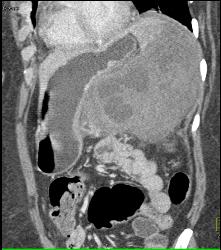 GIST Tumor - CTisus CT Scan