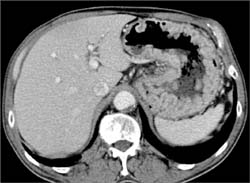 Renal Cancer With Hypertrophied Gastric Folds- Zollinger-Ellison - CTisus CT Scan