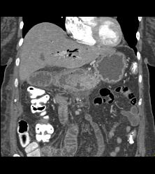 Antral Carcinoma - CTisus CT Scan