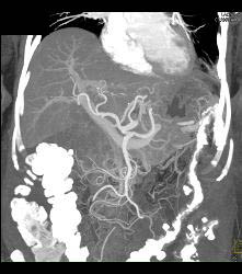 Antral Carcinoma - CTisus CT Scan