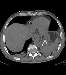 Stent in Gastroesophageal (GE) Junction Gets Loose in Stomach - CTisus CT Scan