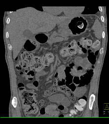 Stent in Gastroesophageal (GE) Junction Gets Loose in Stomach - CTisus CT Scan