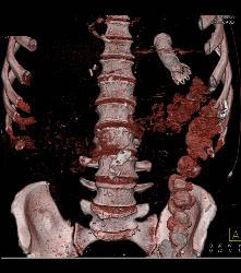 Stent in Gastroesophageal (GE) Junction Gets Loose in Stomach - CTisus CT Scan