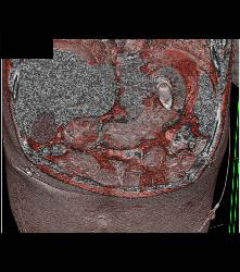 Stent in Gastroesophageal (GE) Junction Gets Loose in Stomach - CTisus CT Scan