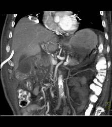 Gastric Emphysema Portal Venous Air and Collection S/p Whipple Procedure. Anastomotic Leak Seen - CTisus CT Scan