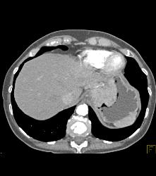 Gastric Adenocarcinoma With Nodes - CTisus CT Scan