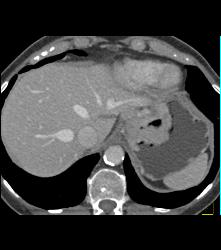 Gastric Adenocarcinoma With Nodes - CTisus CT Scan