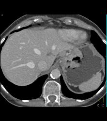 Gastric Adenocarcinoma With Nodes - CTisus CT Scan