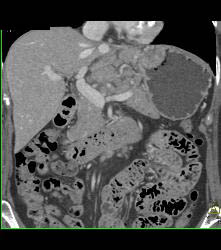 Gastric Adenocarcinoma With Nodes - CTisus CT Scan