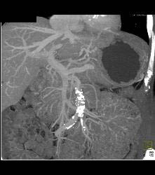 Gastric Adenocarcinoma With Nodes - CTisus CT Scan