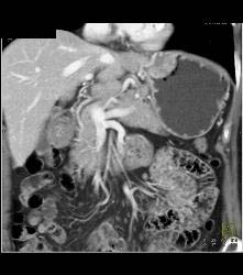 Gastric Adenocarcinoma With Nodes - CTisus CT Scan