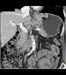 Gastric Adenocarcinoma With Nodes - CTisus CT Scan