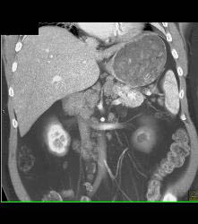 Gastric Adenocarcinoma With Nodes - CTisus CT Scan