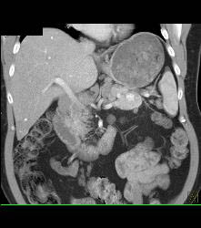 Gastric Adenocarcinoma With Nodes - CTisus CT Scan