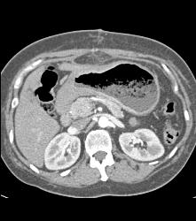 Antral Cancer With Gastric Outlet Obstruction - CTisus CT Scan