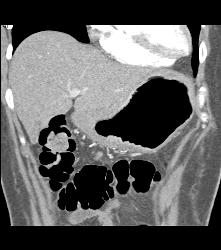 Antral Cancer With Gastric Outlet Obstruction - CTisus CT Scan