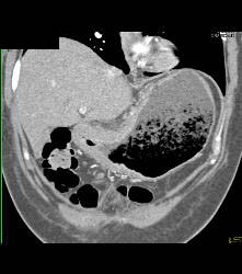 Antral Cancer With Gastric Outlet Obstruction - CTisus CT Scan