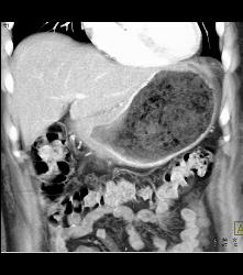 Antral Cancer With Gastric Outlet Obstruction - CTisus CT Scan