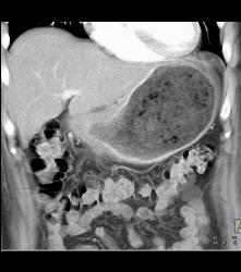 Antral Cancer With Gastric Outlet Obstruction - CTisus CT Scan