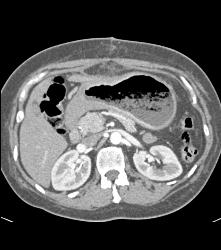 Antral Cancer With Gastric Outlet Obstruction - CTisus CT Scan