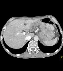 Bulky Adenocarcinoma of the Stomach With Nodes - CTisus CT Scan