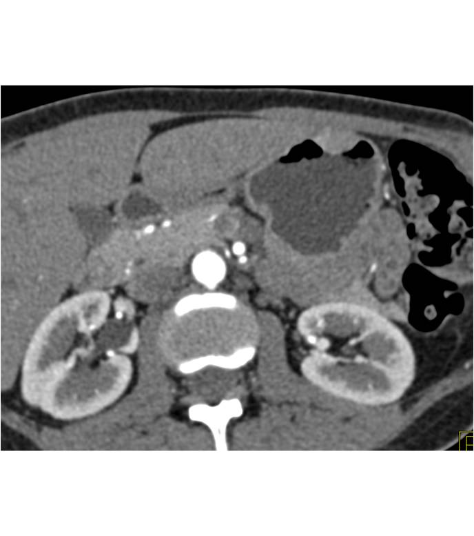 Gastric GIST Tumor - CTisus CT Scan