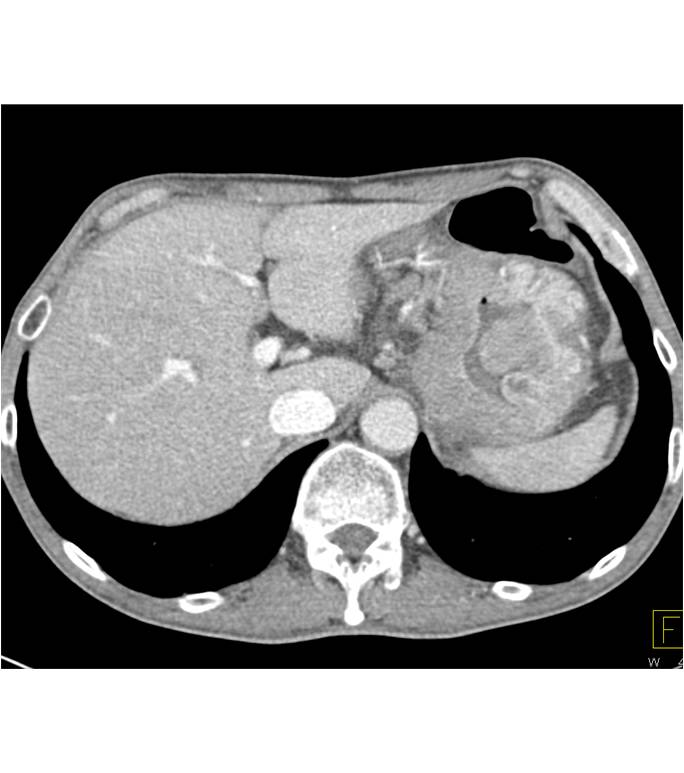 Bulky Gastric Adenocarcinoma - CTisus CT Scan