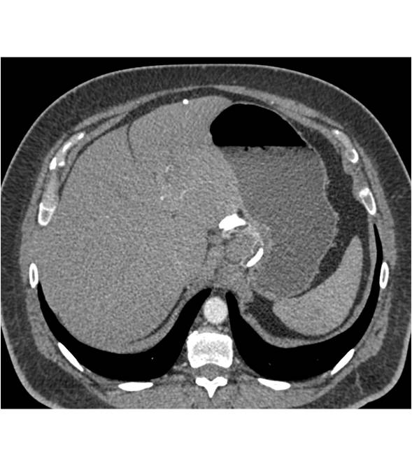 Vanguard Devise at Gastroesophageal (GE) Junction for Weight Reduction Surgery - CTisus CT Scan