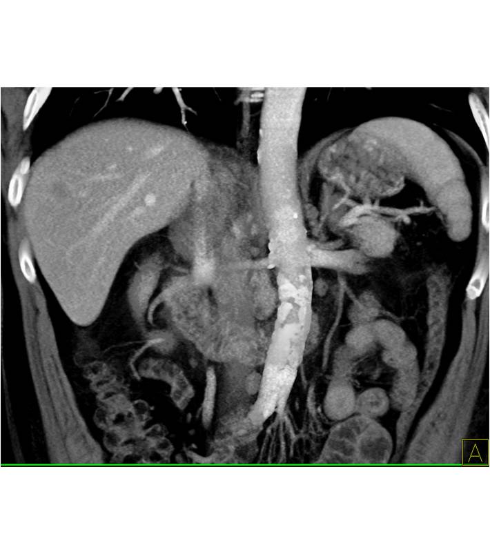 Gastric Adenocarcinoma with Liver Metastases and Adenopathy and Adrenal Metastases - CTisus CT Scan