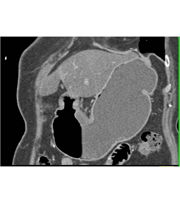 Antral Carcinoma - CTisus CT Scan