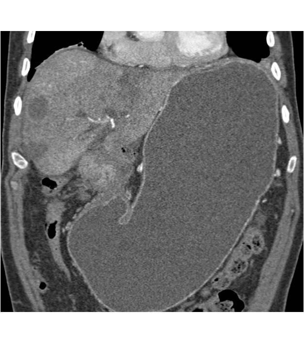 Antral Carcinoma with Adenopathy and Liver Metastases - CTisus CT Scan