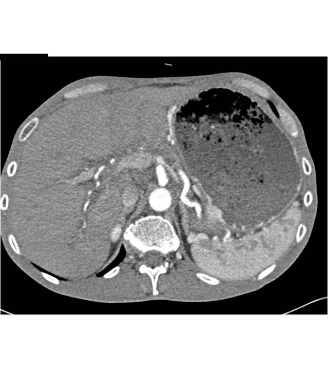 Delayed Gastric Emptying - Stomach Case Studies - CTisus CT Scanning