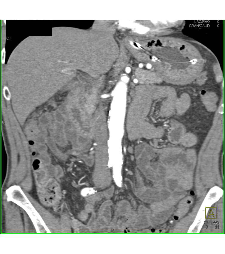 Gastritis - CTisus CT Scan