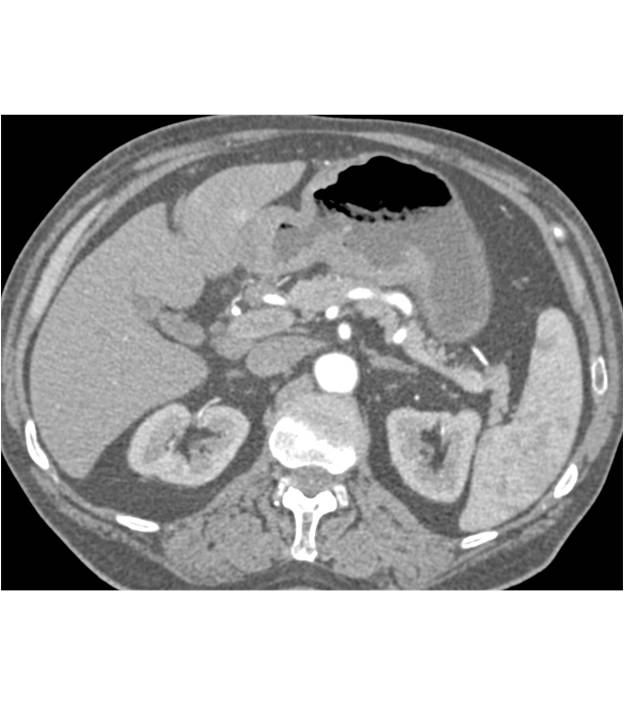 Infiltrating and Ulcerating Gastric Cancer - CTisus CT Scan