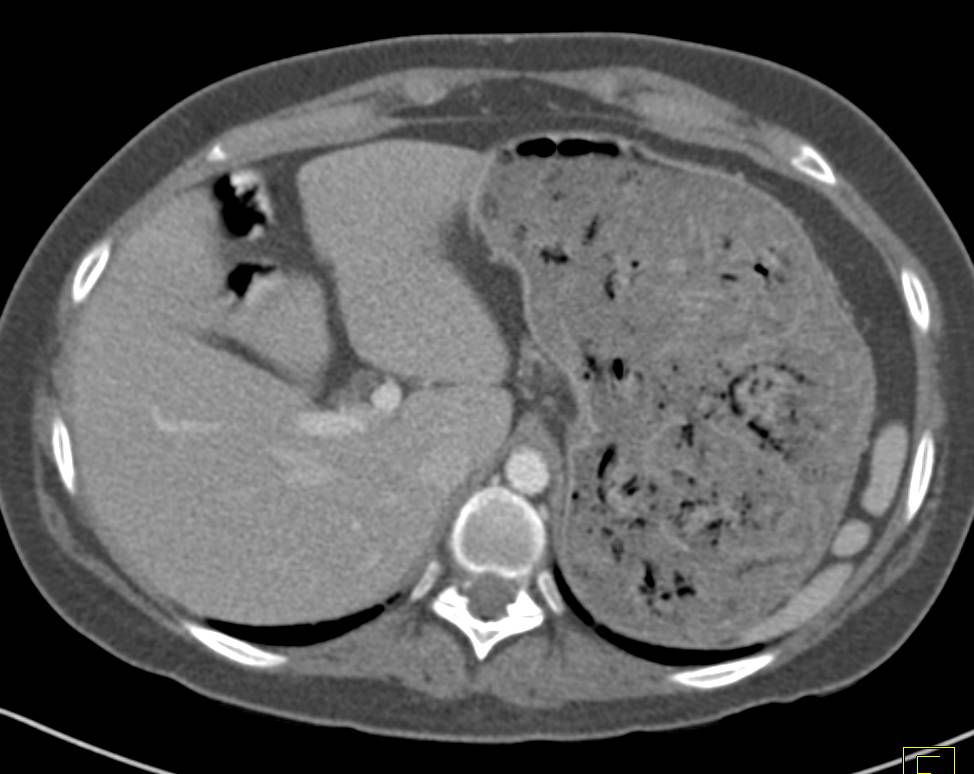 Spaghetti in Stomach Simulates a Filling Defect in Stomach - CTisus CT Scan