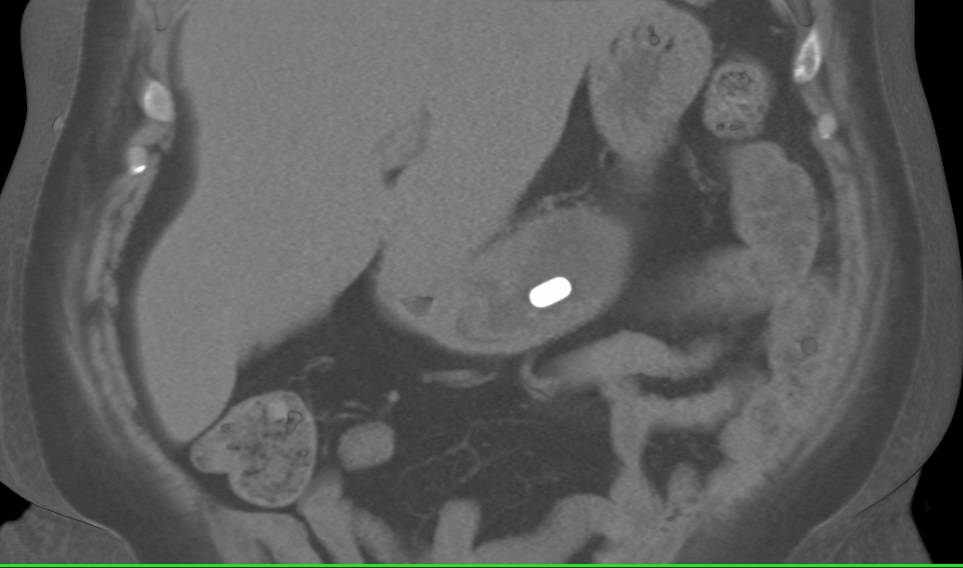 Pill in the Stomach - CTisus CT Scan