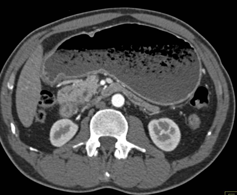 Antral Carcinoma and Incidental Liver Mass that is Focal Nodular Hyperplasia - CTisus CT Scan