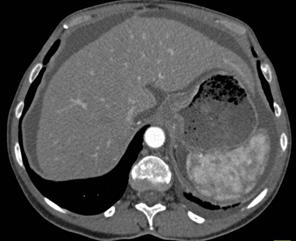 Infiltrating Gastric Cancer with Carcinomatosis - CTisus CT Scan