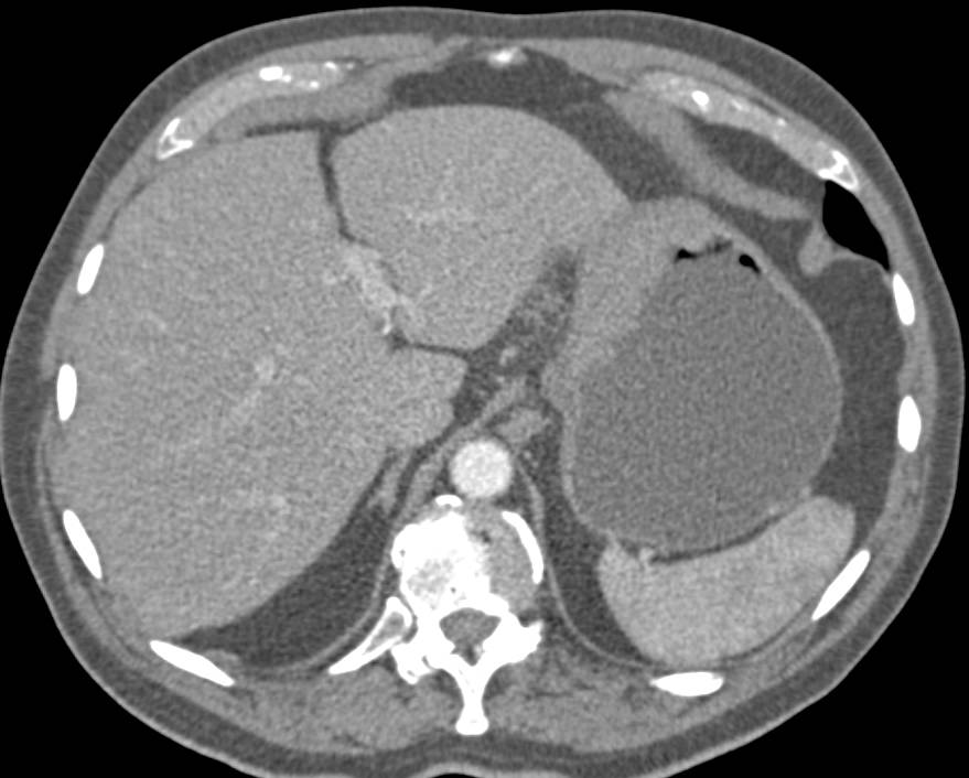 Infiltrating Gastric Carcinoma - CTisus CT Scan