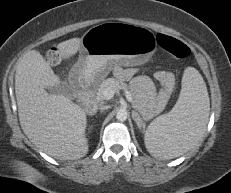 Subtle Antral Carcinoma - CTisus CT Scan