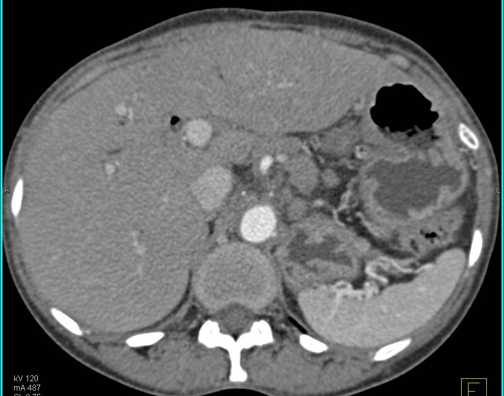 Gastritis - CTisus CT Scan