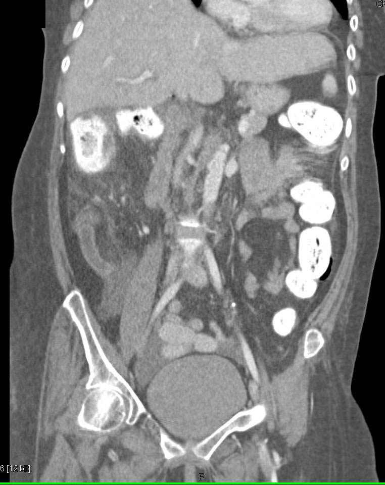 Poorly Position Gastrostomy Tube (Outside Stomach) - CTisus CT Scan