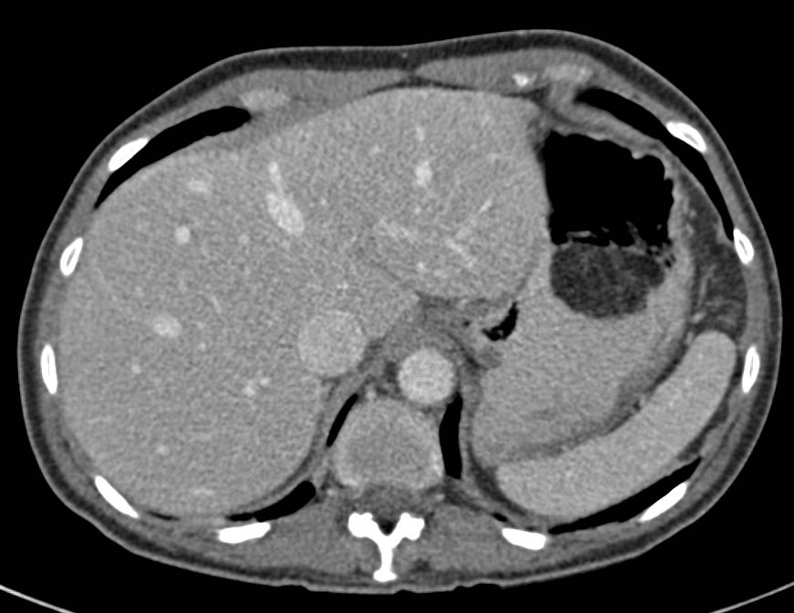 Gastric Lipoma - Stomach Case Studies - CTisus CT Scanning