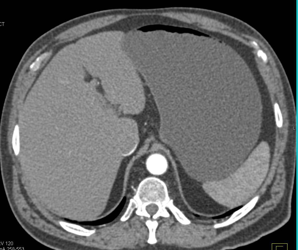 Duodenal Cancer Causing Gastric Outlet Obstruction - CTisus CT Scan