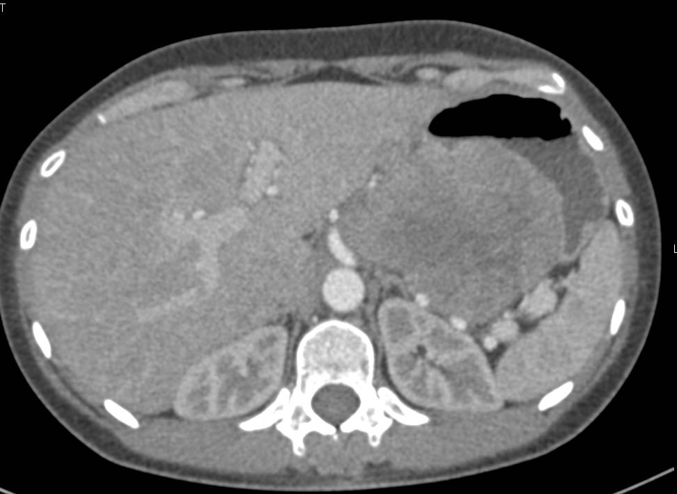 Gastric GIST Tumor - CTisus CT Scan