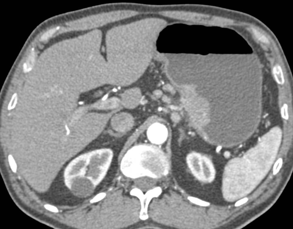 Impressive 3D Mapping of Adenocarcinoma of Gastroesophageal (GE) Junction with Celiac Nodes. Tumor Extent Best Defined on 3D VRT Images - CTisus CT Scan