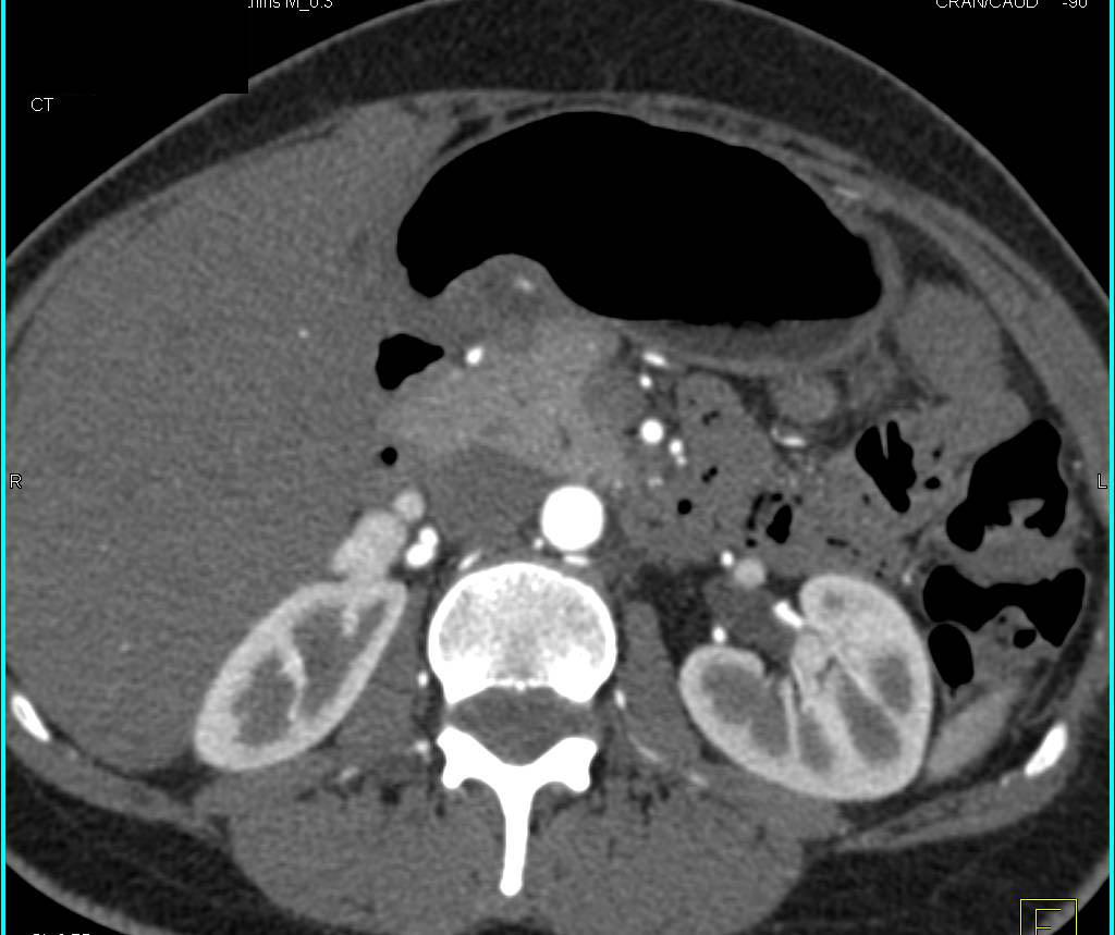 Duplication Cyst in Gastric Antrum in 3D. Incidental Focal Nodular Hyperplasia (FNH) Also Seen - CTisus CT Scan