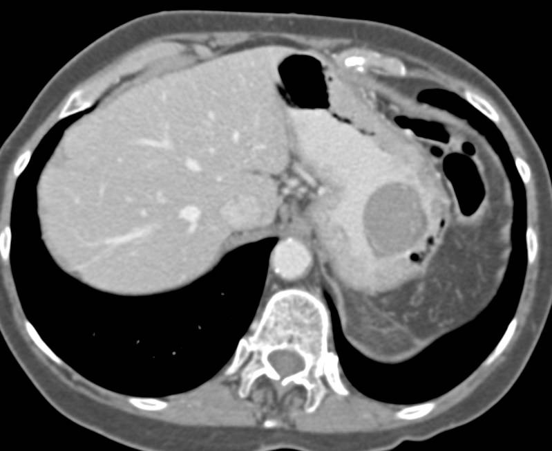 Incidental Gastric GIST Tumor - CTisus CT Scan